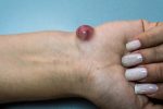 cysts