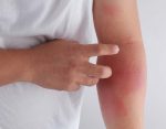 dermatitis