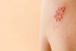 herpes2