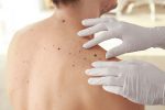 moles