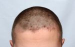 sebderm