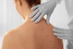 skincancer