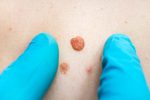 skintag