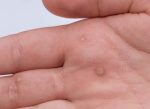 warts