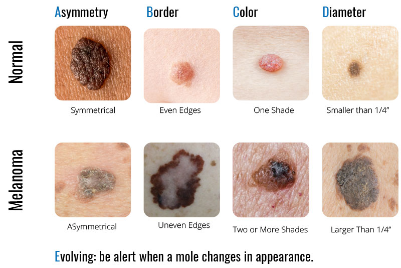 Image result for skin cancer